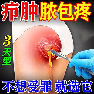 火疖子拔毒拔脓膏疖肿粉瘤皮脂腺囊肿大腿外阴脓包硬块火疖子膏药