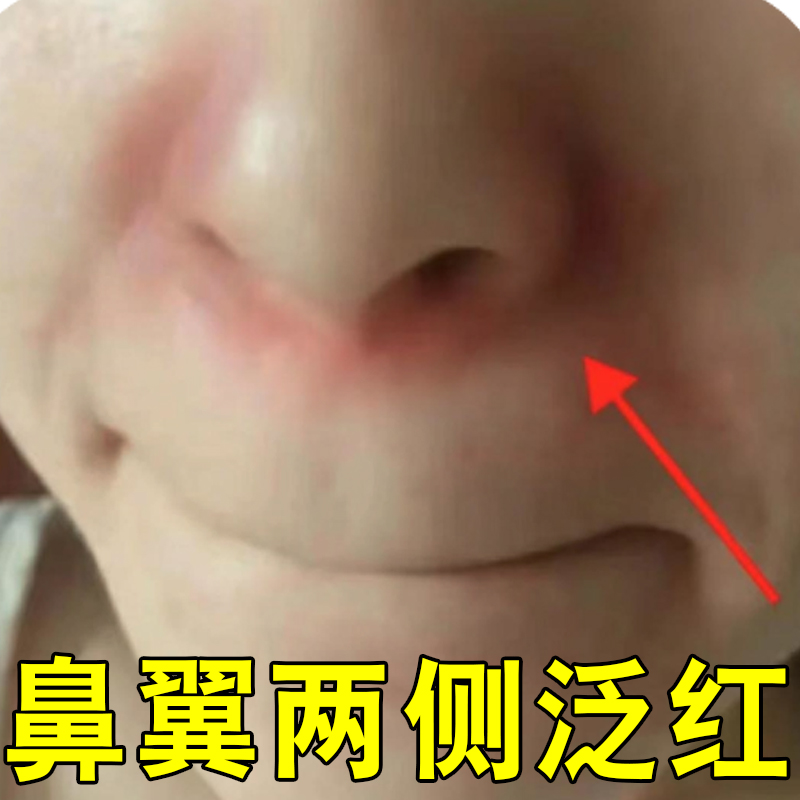 鼻子两侧发红起皮鼻翼两边泛红脱皮脂溢性过敏干燥鼻子长痘痘红痒