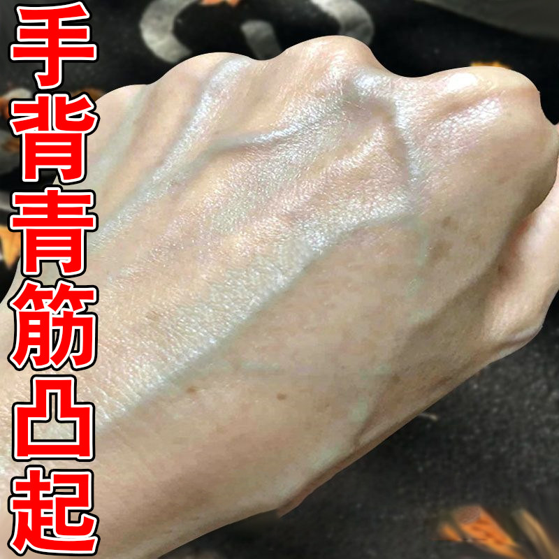 手背青筋凸起引起毛细血管扩张手上长青筋暴起冷敷凝胶膏