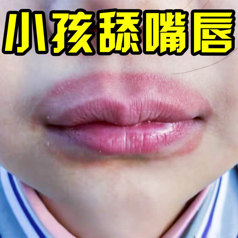 儿童唇焱外用膏舔嘴唇嘴巴一圈红上火起水小泡去羊胡子疮防干裂药