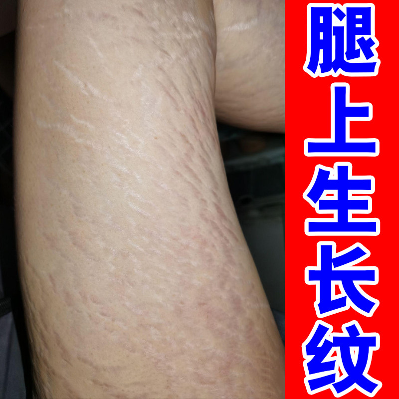 肥胖纹去除修复霜生长纹消除大腿学生腰腹部淡化纹路去肥胖纹专用
