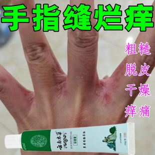手指缝溃烂痒烂手丫专用膏药手指间经常碰水糜烂发红脱皮长水泡痒