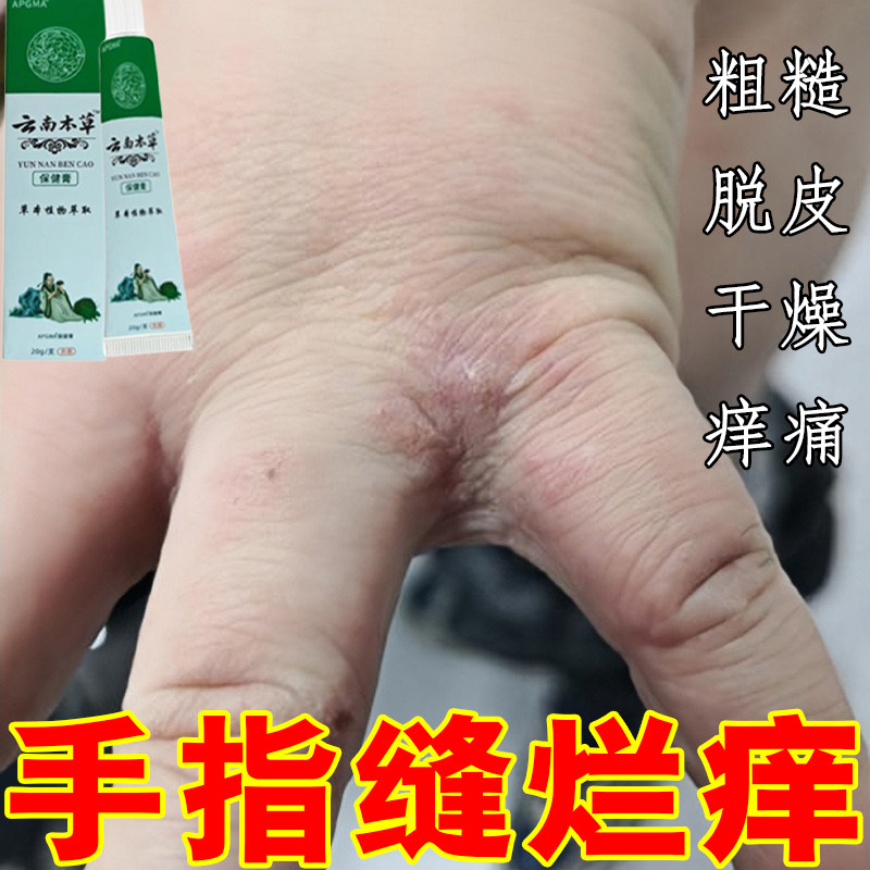 烂手丫药手指缝溃烂经常碰水脱皮长水泡发红干裂口糙痒手起专用霜
