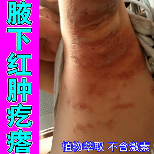 腋下肌肤泛红积汗黏腻走动摩擦不适腹股沟胯下内侧皮肤闷热不透气