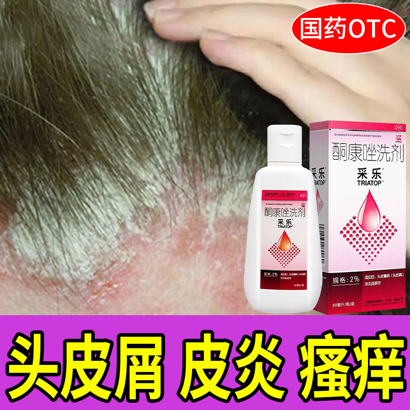 采乐酮康唑洗剂治头皮屑脂溢性皮炎瘙痒红肿去头屑止痒复洗发水方
