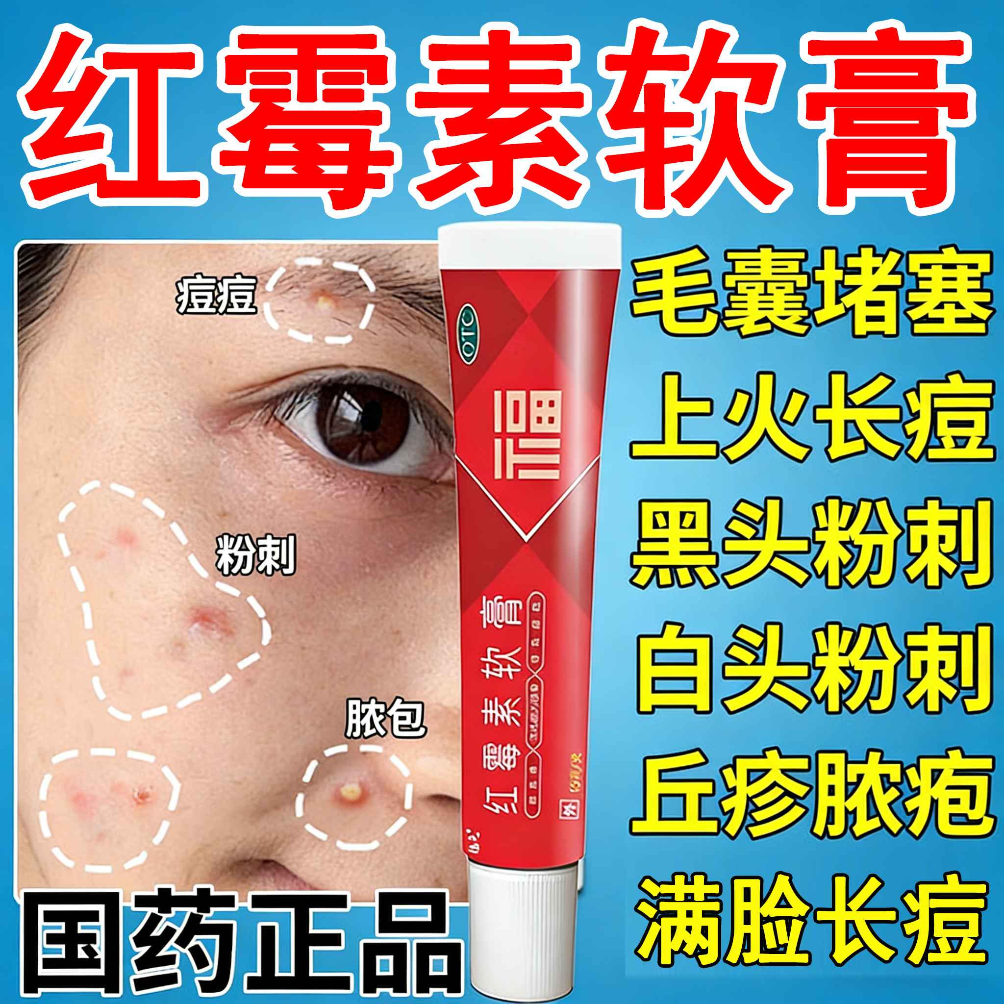 红霉素软膏消炎杀菌皮肤感染真菌痤疮化脓抗菌脓包痘痘私处外用