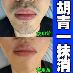 胡青去除淡化黑印永久抑制生长祛脸黑色素胡茬络腮胡遮瑕软化根膏