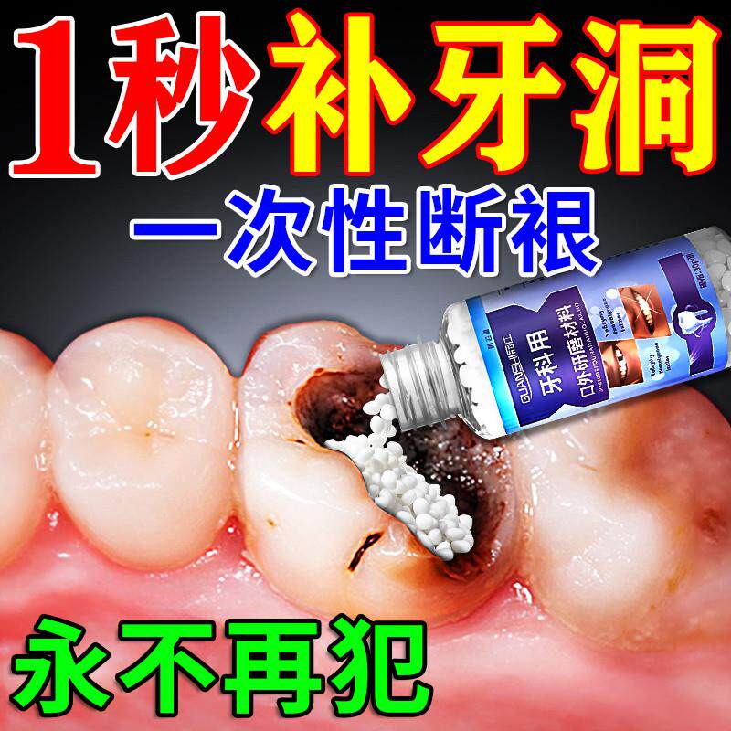 补牙神器自己填充蛀牙龋齿修覆在家补牙齿洞膏补牙缝材料永久医用