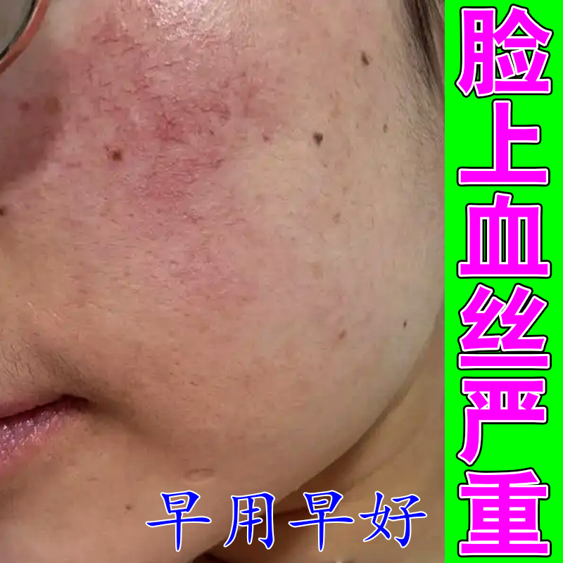 脸上红血丝严重熬夜上火长痘草本皮肤消毒护理（消）