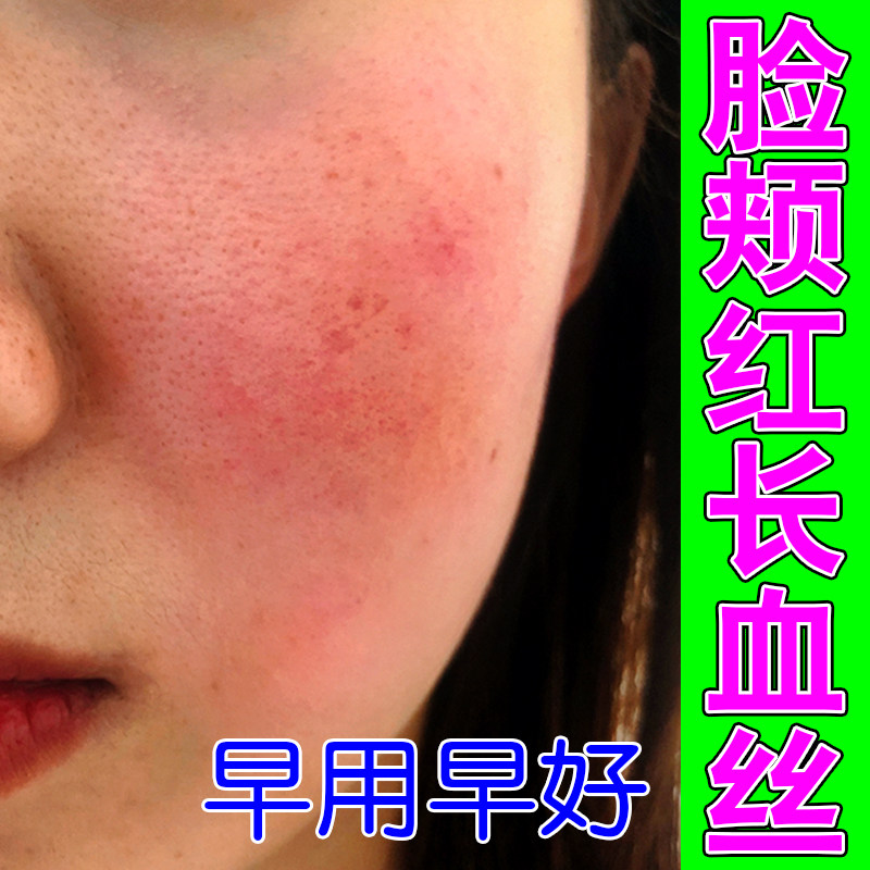 脸颊红血丝脸部泛红脸上有红血丝皮肤消毒护理（消）