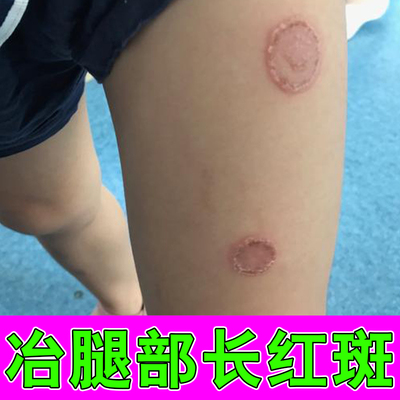 腿上皮肤长铜钱状圆斑皮肤痒专用腿上长圆形红斑干燥起白屑红疙瘩
