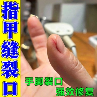 指甲缝手指头裂口子干裂修复霜手指尖开裂疼痛防皲裂脱皮愈合乳膏