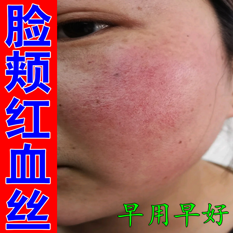 脸上红血丝严重熬夜上火长痘草本皮肤消毒护理（消）