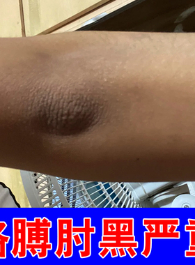 胳膊肘发黑严重皮肤粗糙手肘关节膝盖脖子腋下皮肤黑色素沉淀严重