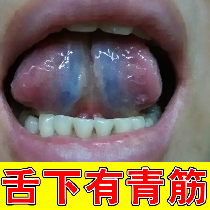 舌底紫血管舌下青筋黑粗淤血疏通怒张口腔溶栓液喷剂药