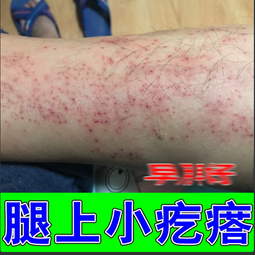 小腿长红点丘疹痒夏天小腿皮肤小红点腿上干燥痒外用修复膏