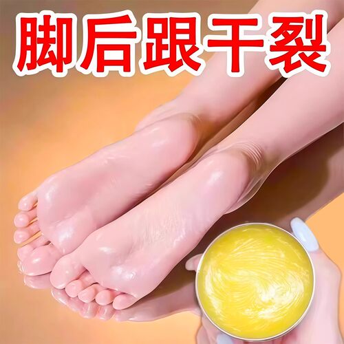脚后跟开裂起皮足裂手足干裂