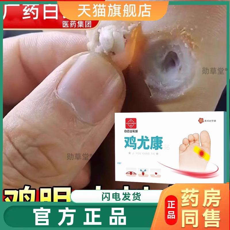 正品白云山鸡眼贴膏脚鸡眼去除脚底手上肉刺老茧专用根手部足部神