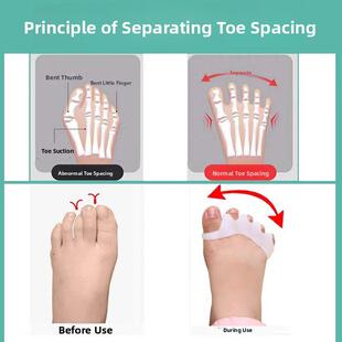 婴儿和儿童拇趾矫正器内扣式拇趾分离器矫正拇指外翻重叠婴儿拇趾