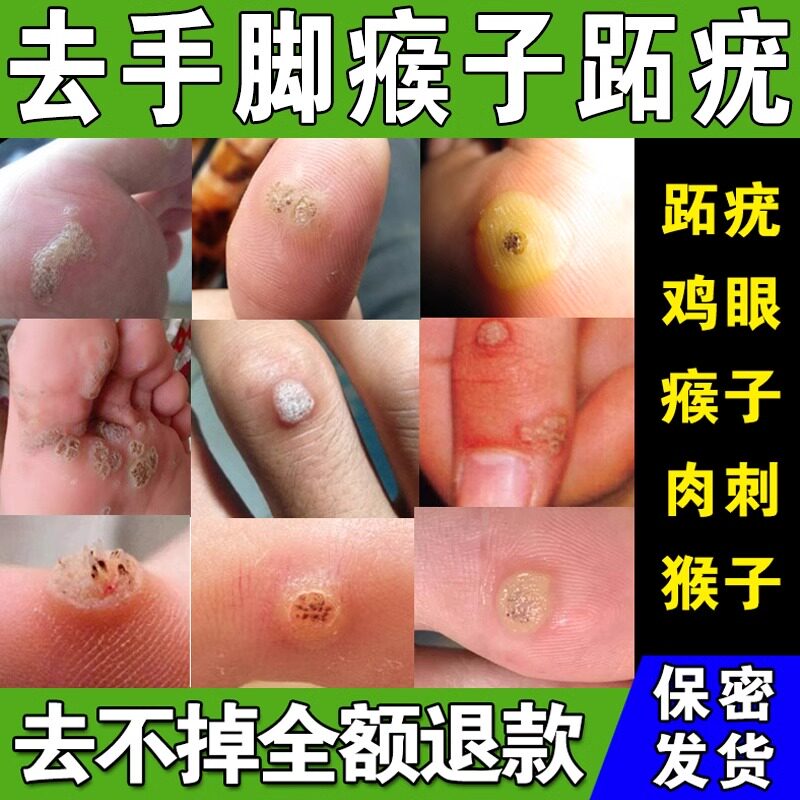 跖疣膏去猴子肉粒疙瘩手脚上长鸡眼膏贴寻常疣脚底肉刺去除膏神器