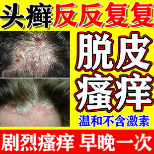 治头部头皮癣药膏真菌感染结痂脂溢性皮炎头部红斑瘙痒疥疮痤疮w