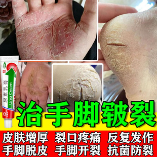 正品老牌子尿素乳膏手癣足癣手足皲裂软膏皮肤干燥痒角化型干裂w