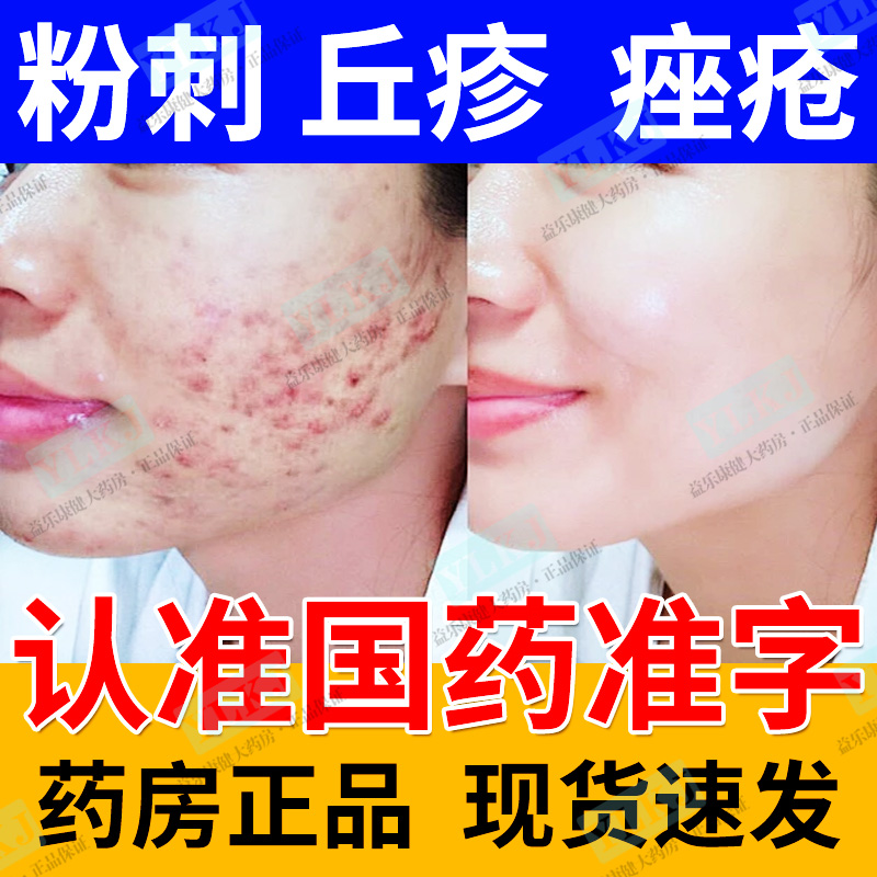 【鑫烨】阿达帕林凝胶0.1%*10g*1支/盒