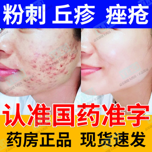 粉刺痘痘药膏治面部前胸后背粉刺丘疹痤疮痘印正品阿达帕林凝胶