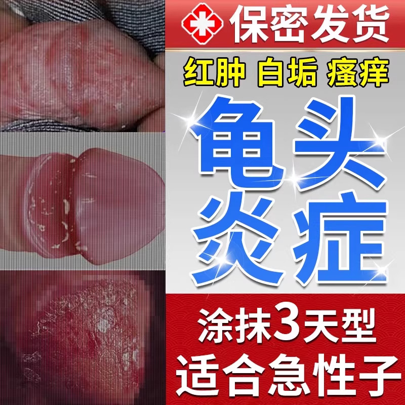 包皮炎龟头炎药膏男性阴茎白垢红肿特非效私处瘙痒念珠菌专非用药