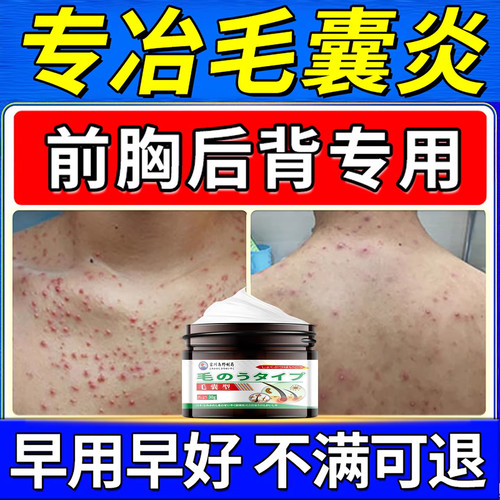 进口专研！！毛囊炎马拉色菌膏