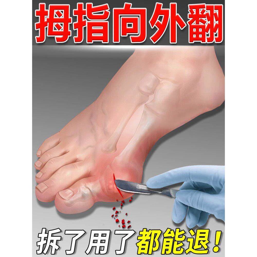 拇外翻软膏贴剂，调节大脚骨痛，畸形肿胀大脚趾专用贴剂