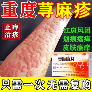 治疗荨麻疹丸过敏止痒断专用根的药物荨麻疹皮肤瘙痒特专效用中药