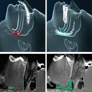 止鼾牙套神器阻止打鼾打呼噜止鼾器呼吸暂停口腔矫治器机防呼噜消