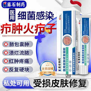 火疖子疖肿搭拔毒拔脓膏包硬块药监备案敷料贴皮脂腺囊肿凝胶E8