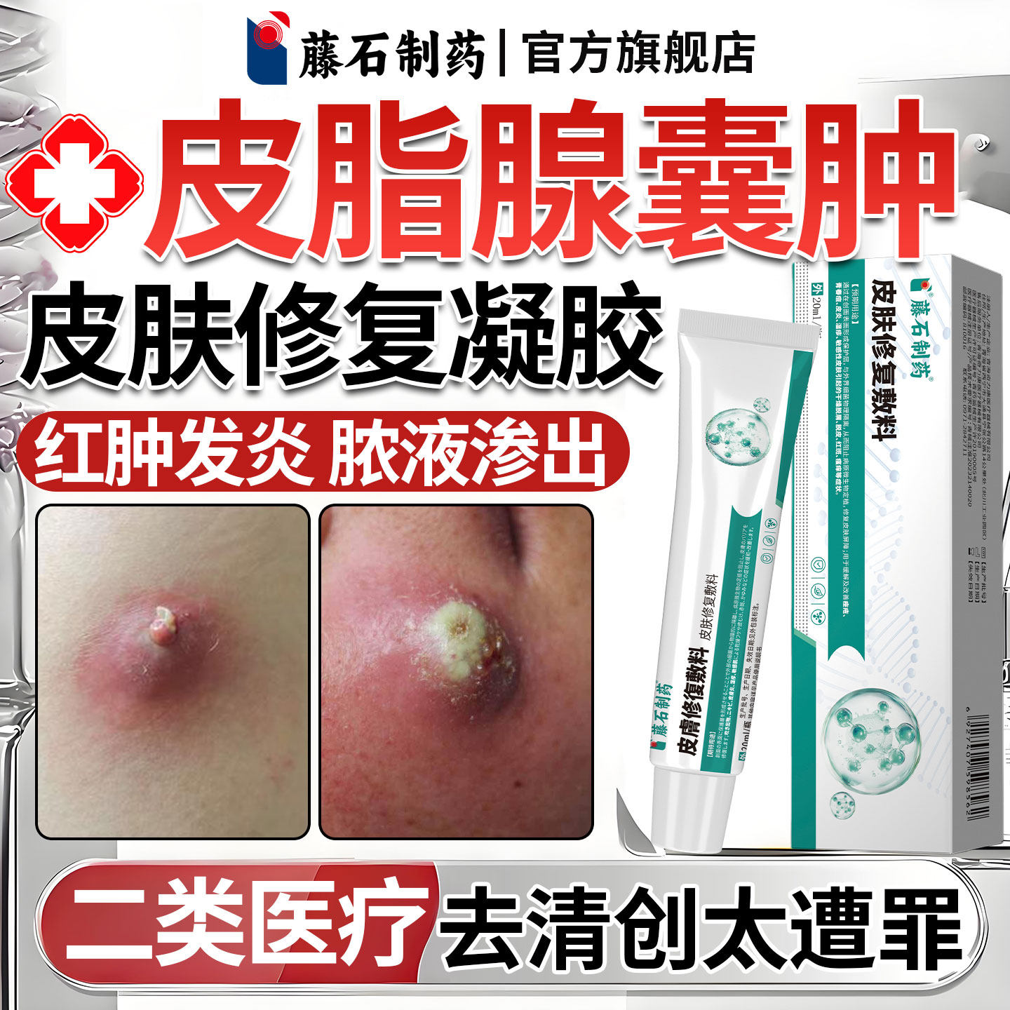 【藤石制药】皮脂腺囊肿医用正品图片