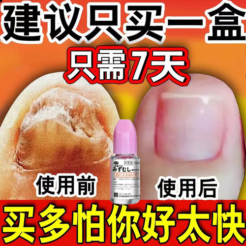 【日本进口】正品小林灰指液甲