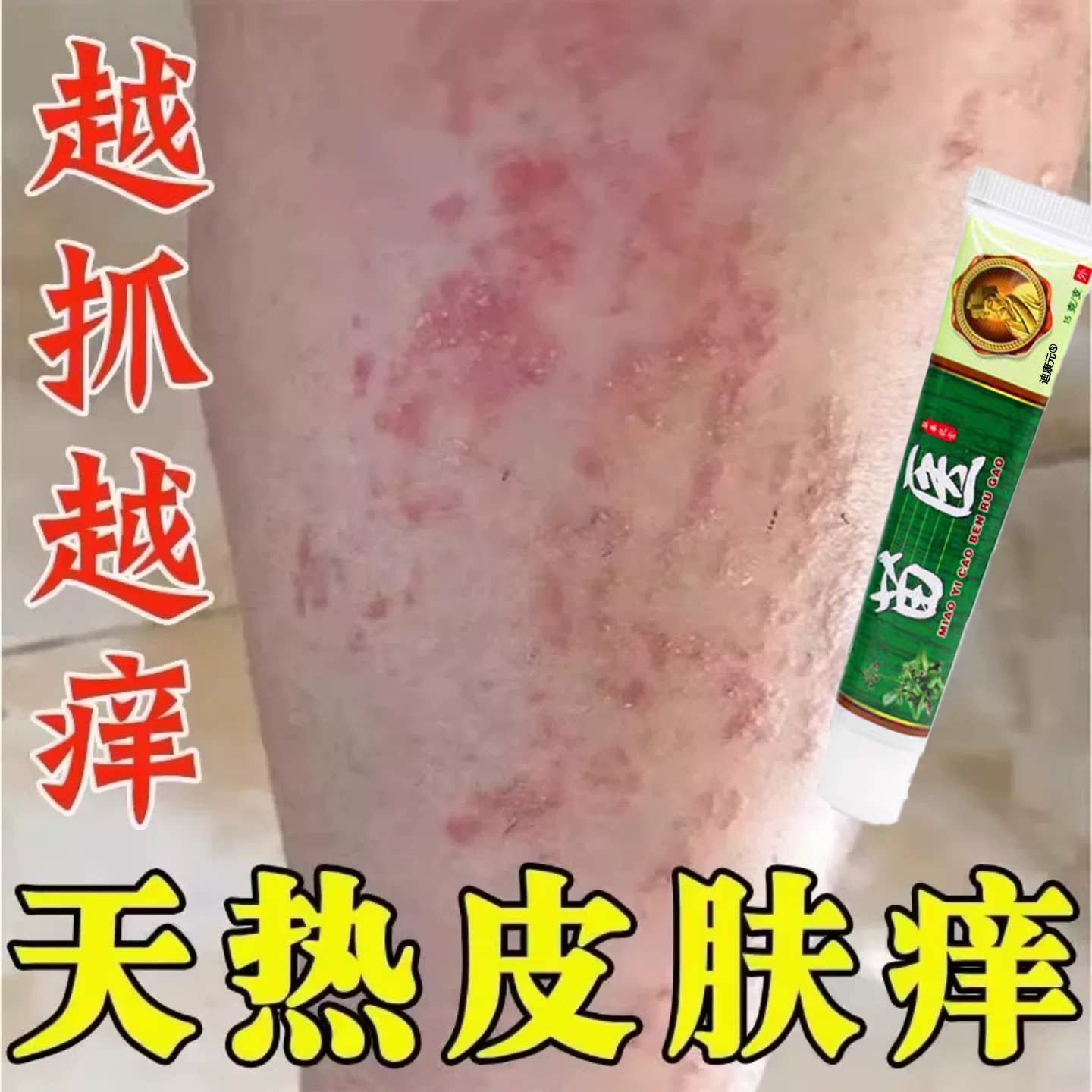 苗医止痒湿热疹痱子皮肤炎膏