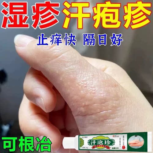 汗疱疹止手痒根起小水泡真菌感染