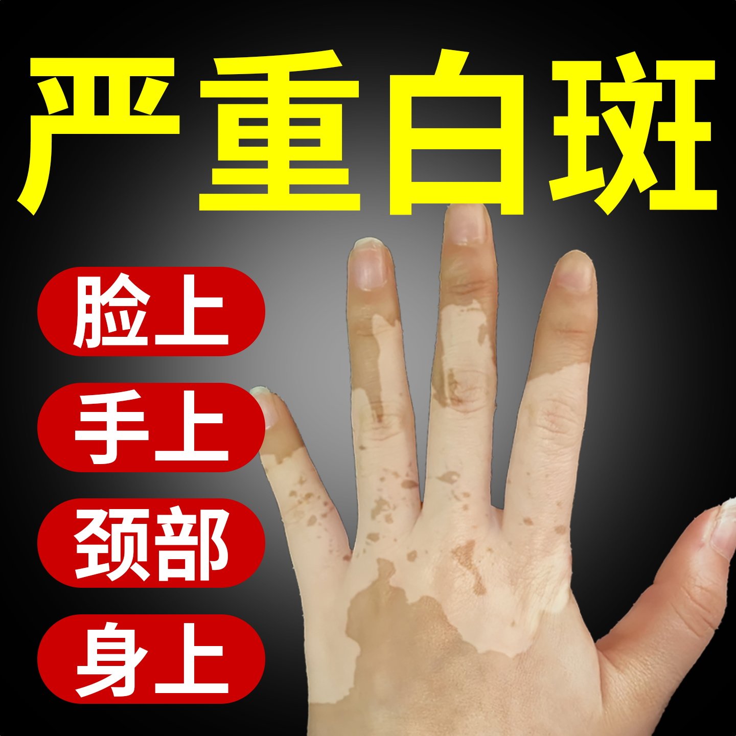 白斑汗斑花斑外用促黑药膏黑色素生长补骨脂酊遮盖液消白汗斑专用