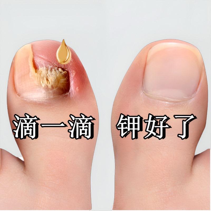 【氏热卖】坏甲变好甲 不伤好钾不脱甲 无痛换新钾 买2送1