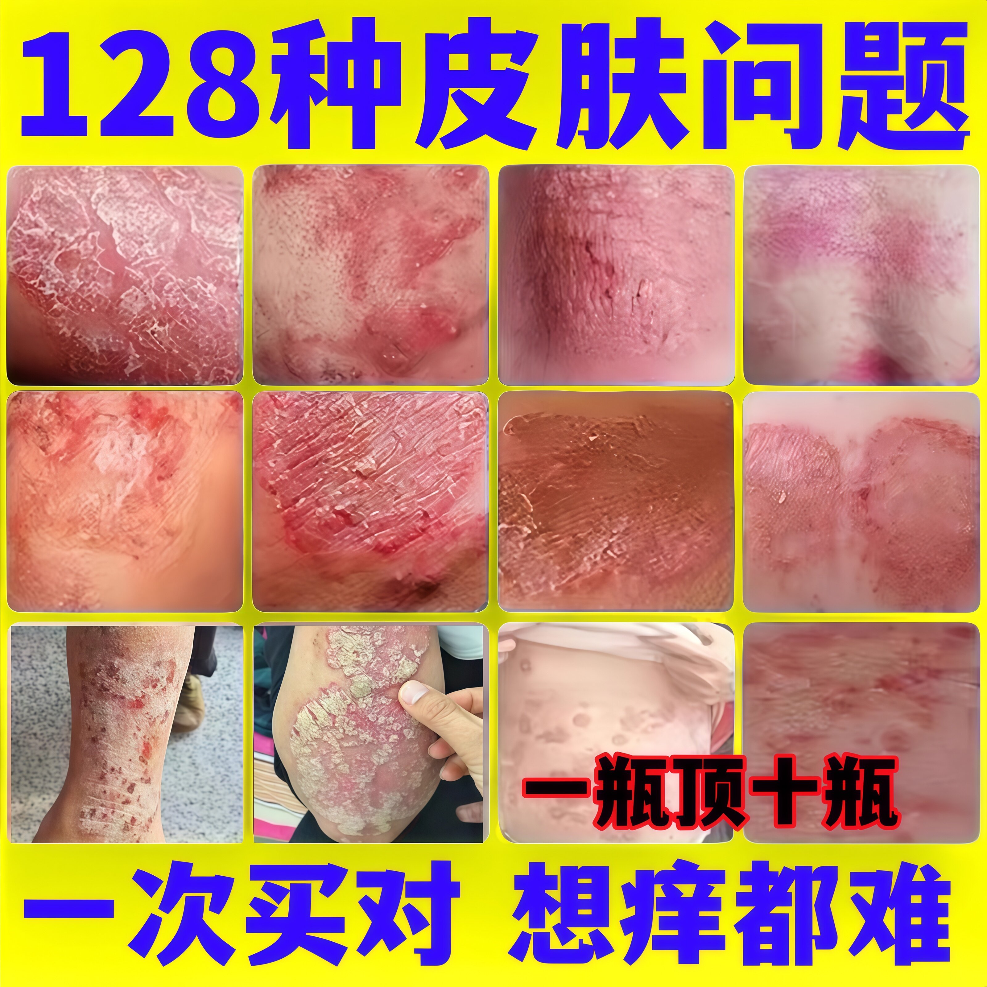 断痒王干痒全身止痒皮肤瘙痒旗舰店正品止顽性牛紫花地丁抑外痒膏
