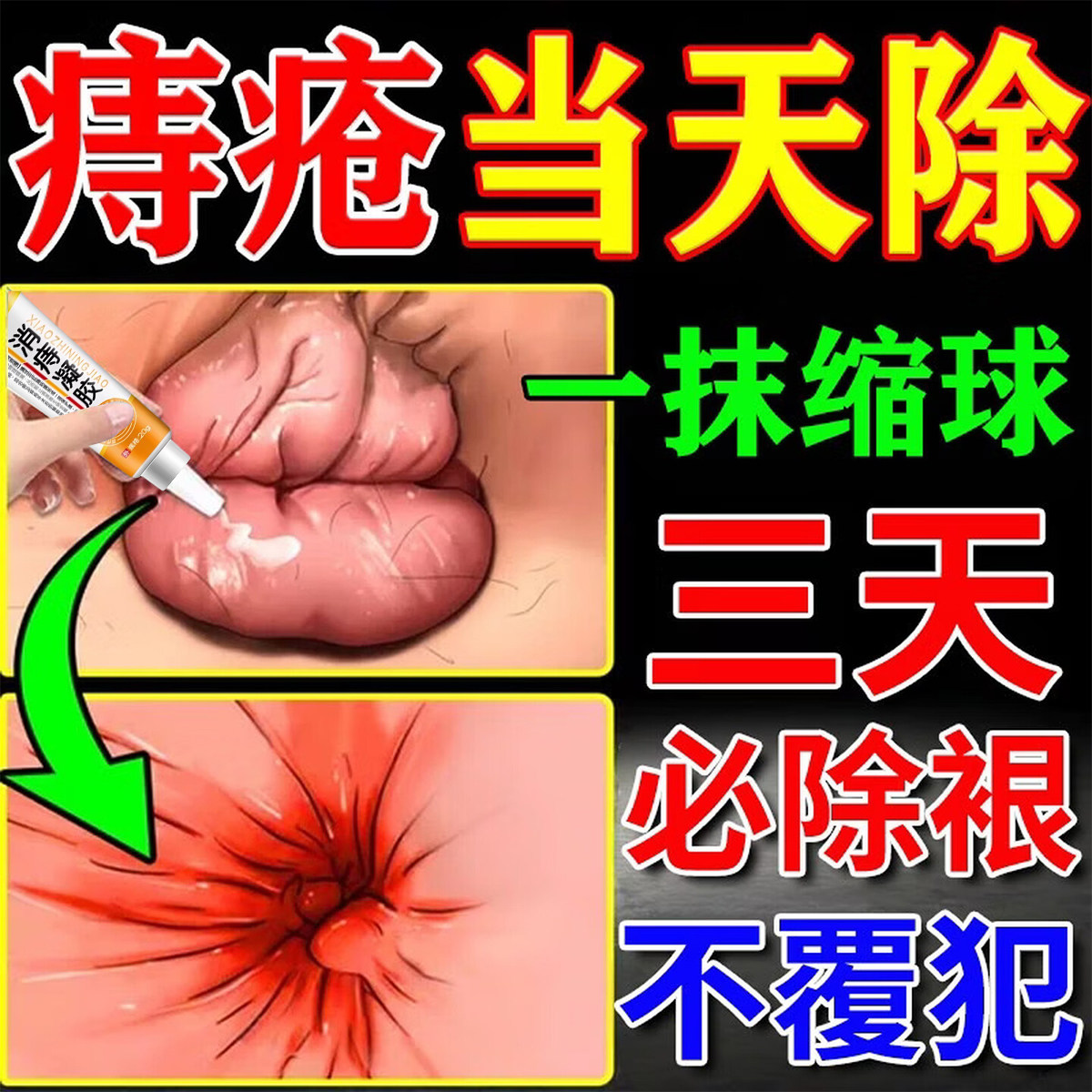 芝芳爽痔疮药膏排行榜第一名芳消肉球消痔凝胶断痣舒枯痔散男女性