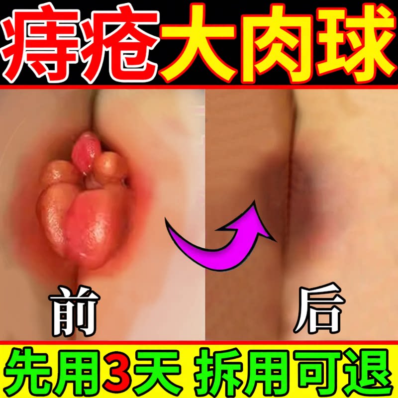 中药内外混合痔止血祛肉球药膏