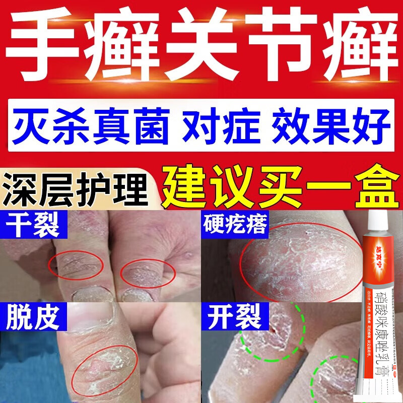 达克宁硝酸咪康唑乳膏正品手癣有脱皮干裂真菌感染专用特新效期药