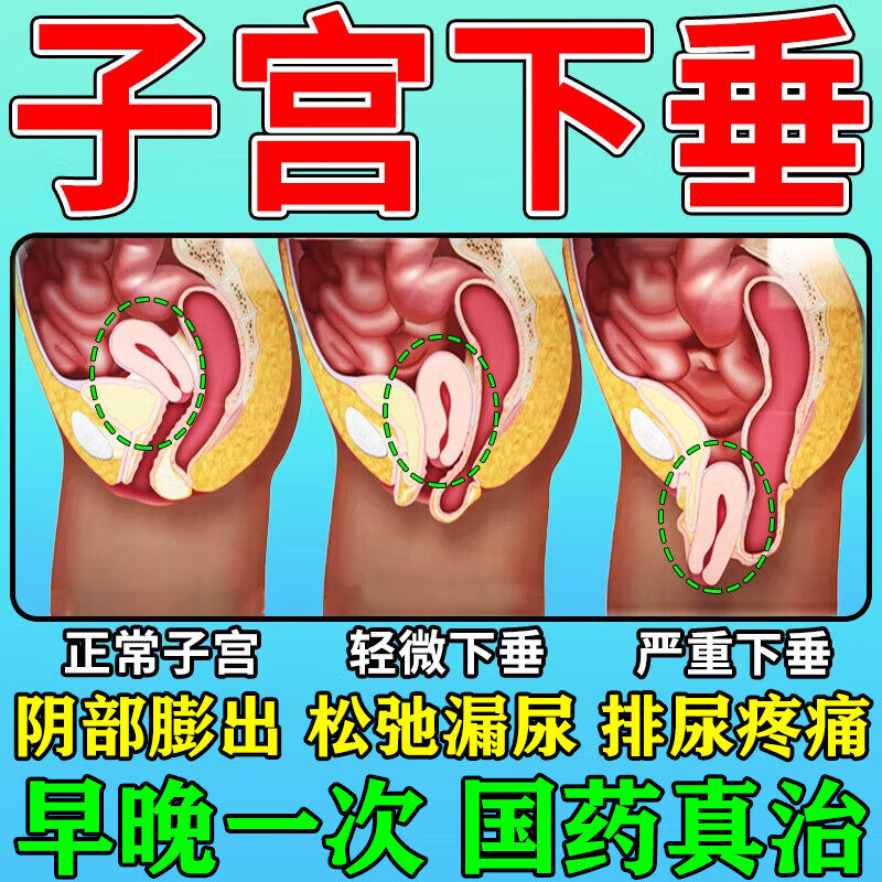 治子宫下垂膨出吃的药子宫下垂托中老年医用小腹坠痛阴道松弛专用