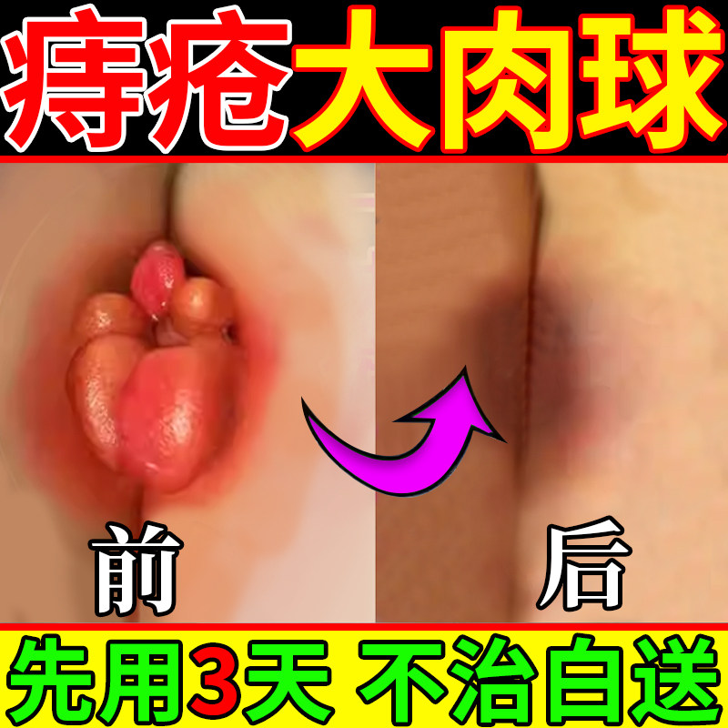 葵花康健百护小白管比尔小蓝痔疮膏痔疮药膏排行榜追第一名痔疮膏