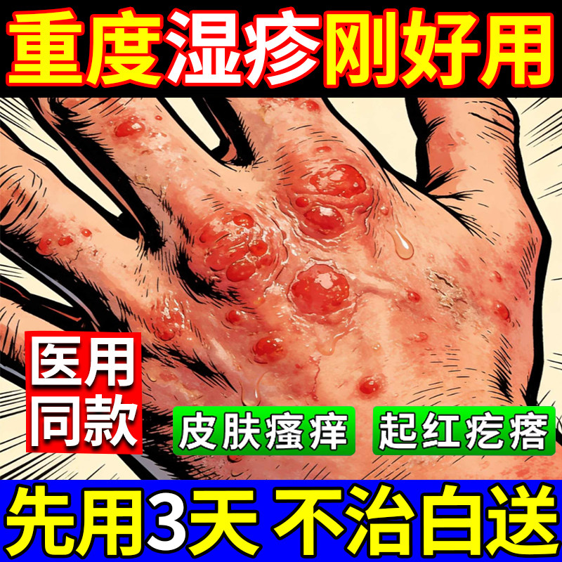 重楼解毒酊湿疹药膏除湿止痒去外用根顽固皮炎欧姆康小白瓶旗舰店