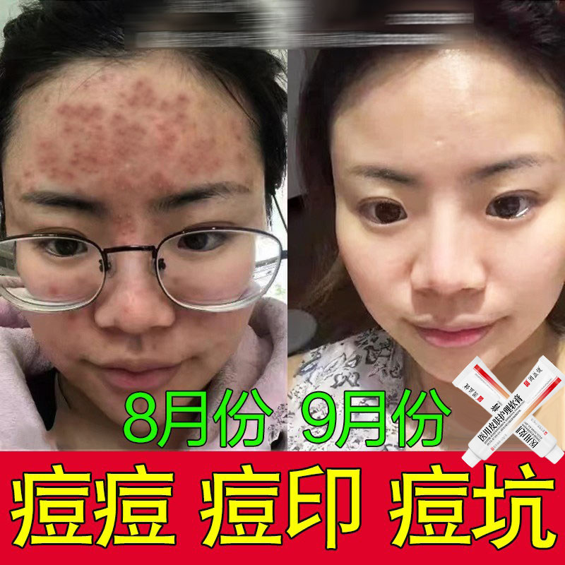 AEKZ小银管vvev凝胶祛痘印闭口透明质酸钠消痘痘修护凝胶脂溢性