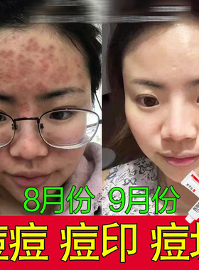 AEKZ小银管vvev凝胶祛痘印闭口透明质酸钠消痘痘修护凝胶脂溢性