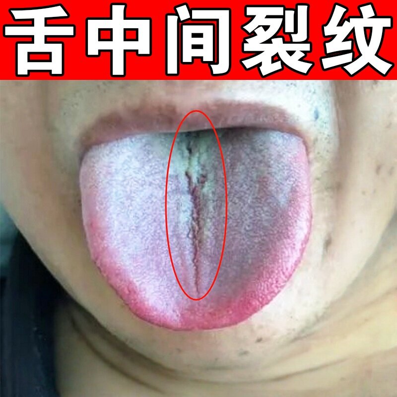 舌头中间裂纹有齿痕舌苔白厚口臭治地图舌肝火旺脾胃健湿气调理药